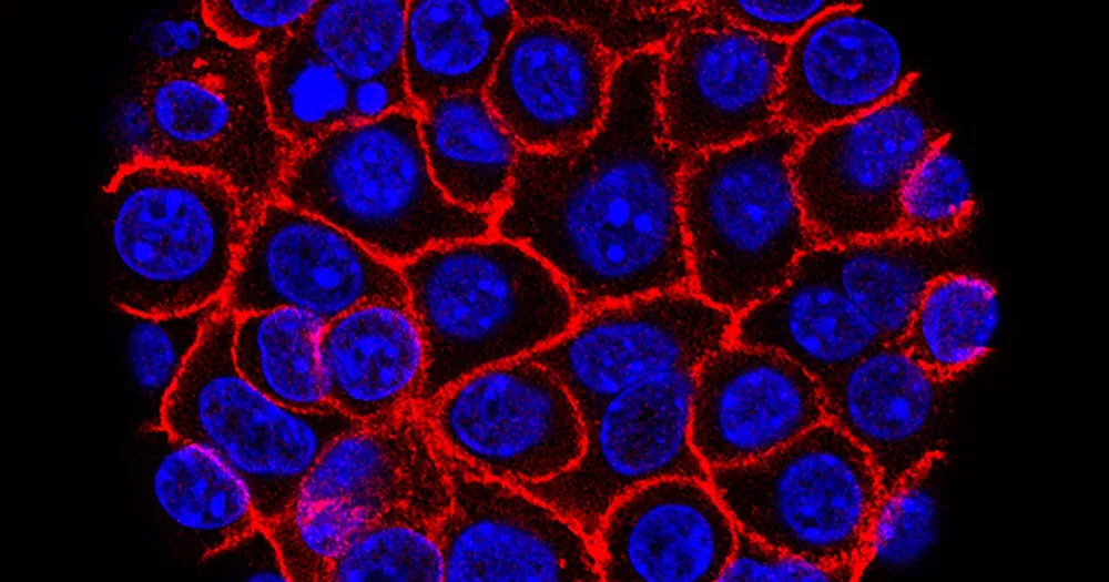 New pancreatic cancer drug daraxonrasib nearly doubles survival time and improves quality of life