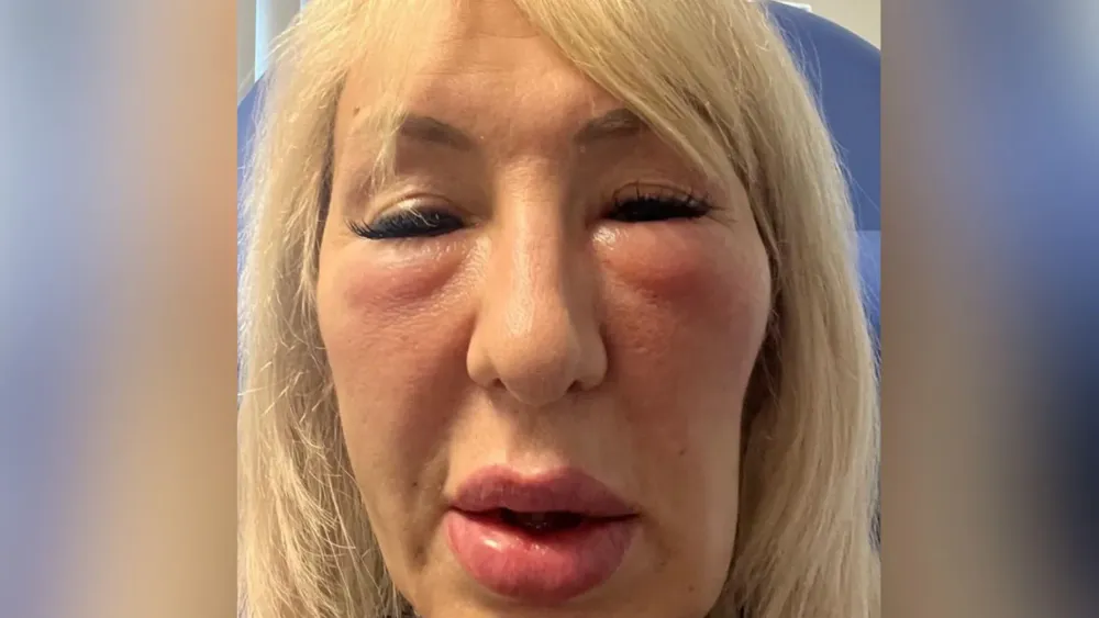 Hull Woman Left Disfigured by Botched Cosmetic Fillers