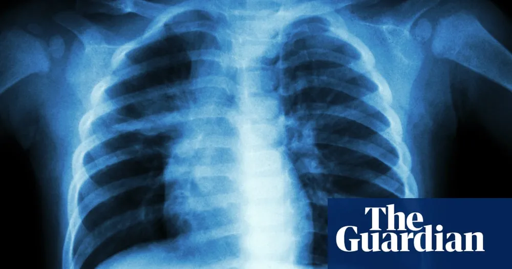 Kansas Tuberculosis Outbreak Becomes One of the Largest in U.S. History