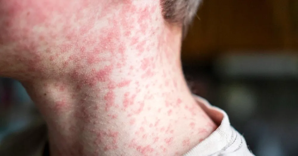 Measles Cases Surge in the U.S., Over 150 Schoolchildren Quarantined in South Carolina