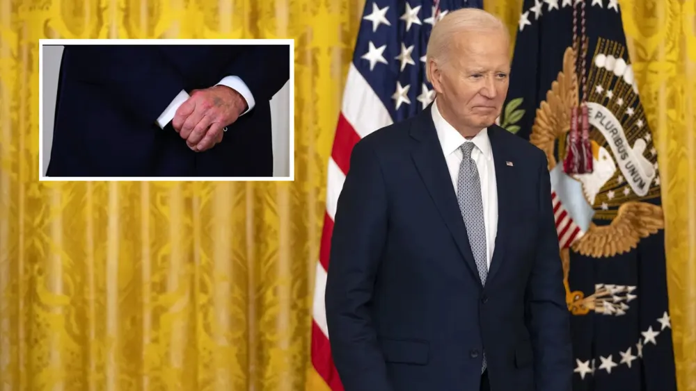 Mystery Surrounds Biden's Purple Bruise, Igniting Theories and Speculations