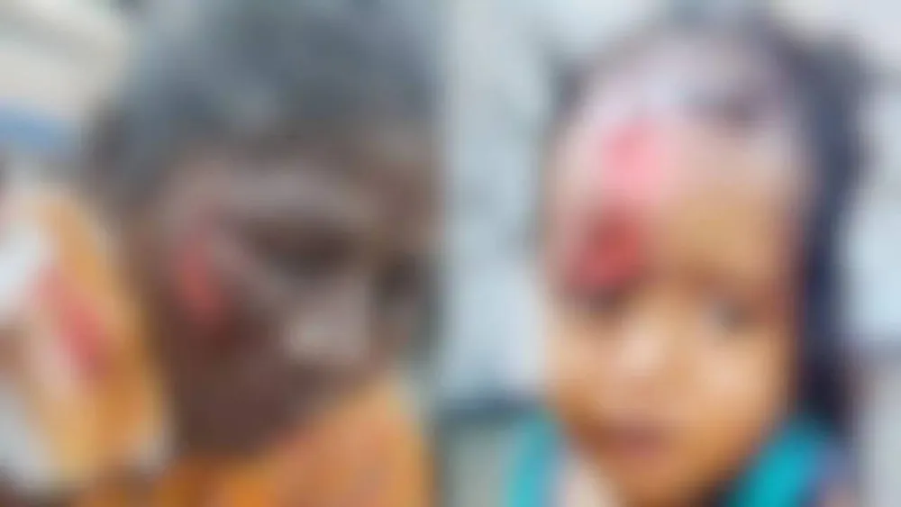 Stray dog attack injures toddler and woman in Coimbatore