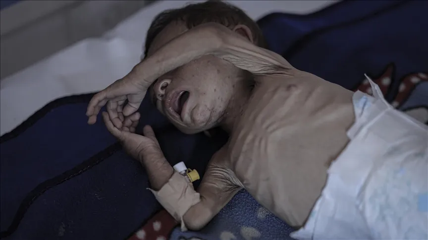 UN warns of catastrophic child malnutrition amid escalating violence in Gaza